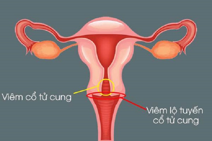 Viêm cổ tử cung có nguy hiểm không là thắc mắc chung của rất nhiều chị em hiện nay