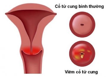 Viêm cổ tử cung có quan hệ được không là thắc mắc chung của rất nhiều chị em hiện nay