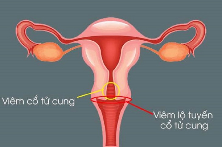 Việc kiêng quan hệ trong quá trình điều trị viêm cổ tử cung là hoàn toàn cần thiết để đảm bảo an toàn