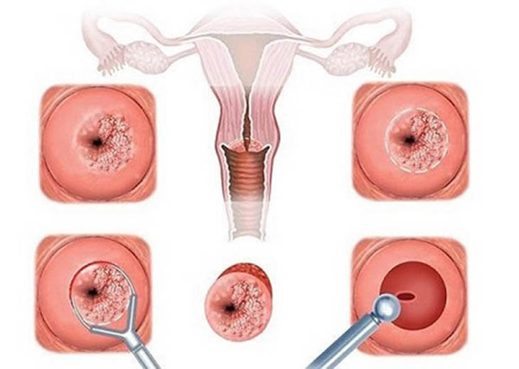 Viêm lộ tuyến dạng sùi nằm ở cấp độ nặng của bệnh, chị em nên tìm hiểu kỹ để có phương pháp điều trị kịp thời