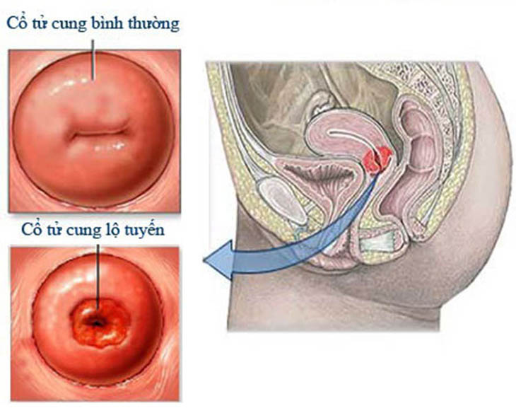 Viêm lộ tuyến tái tạo có những triệu chứng nào rõ nét