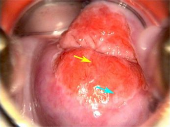 Viêm lộ tuyến ven lỗ là bệnh lỹ phụ khoa thường gặp nhất là ở nữ giới đã quan hệ và có gia đình