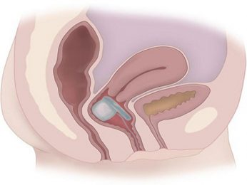 Đặt thuốc viêm cổ tử cung bị chảy máu có nguy hiểm không?