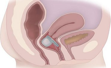 Đặt thuốc viêm cổ tử cung bị chảy máu có nguy hiểm không?