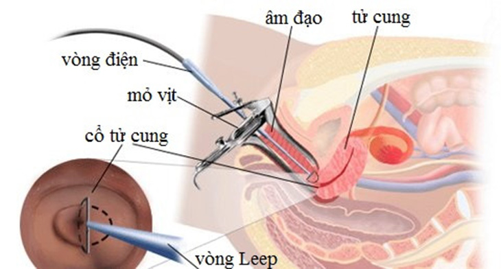 Phương pháp đốt viêm cổ tử cung