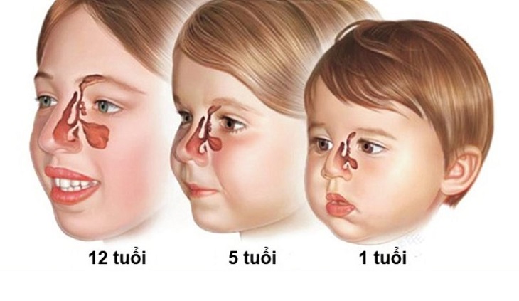 Viêm xoang cấp ở trẻ em