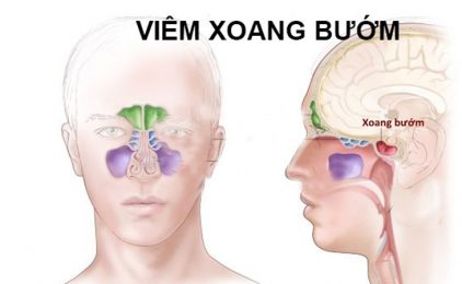 viêm xoang bướm