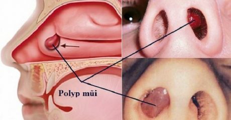 Viêm xoang polyp mũi