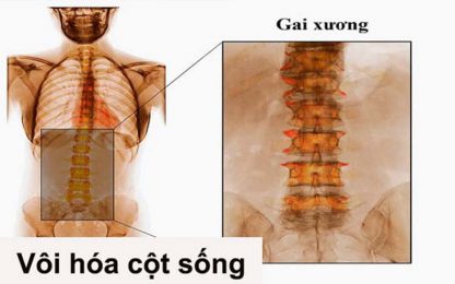 Bệnh vôi hóa cột sống