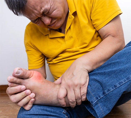 Gout gây đau đớn, ảnh hưởng đến sức khỏe