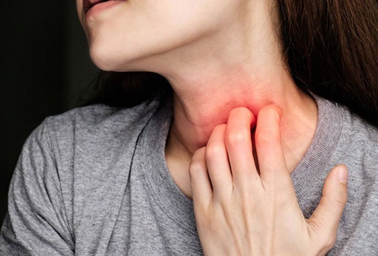 Nhận biết nóng trong người nổi mề đay