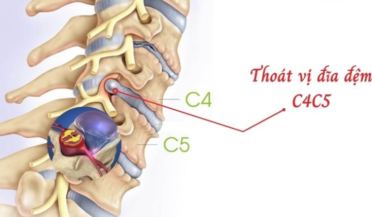 Thoát vị đĩa đệm cổ C4 C5 là gì?