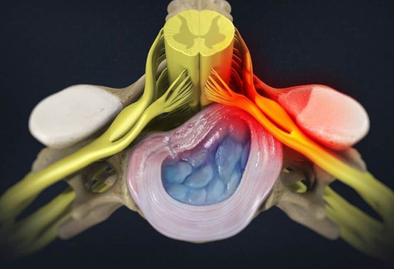 Thoát vị đĩa đệm đốt sống cổ C3 C4 có nguy hiểm không?