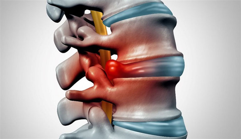 Thoát vị đĩa đệm L4 L5 là gì?