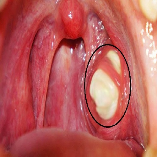 Amidan có đốm trắng 