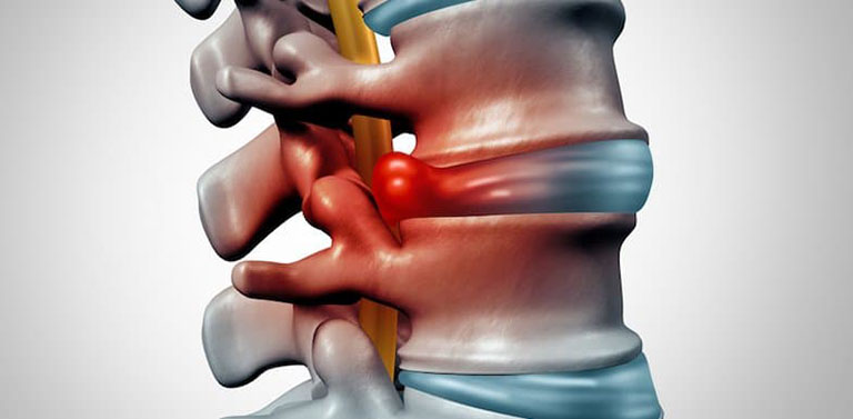 thoát vị đĩa đệm 