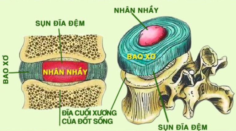 Tìm hiểu về đĩa đệm nhân tạo