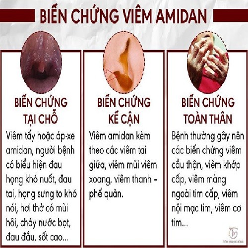 Viêm amidan cấp 