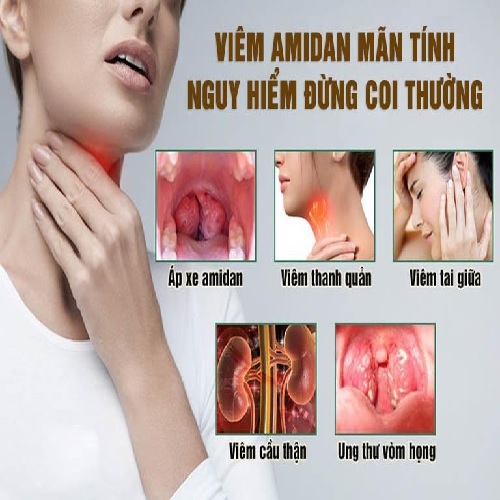 Viêm amidan mãn tính 