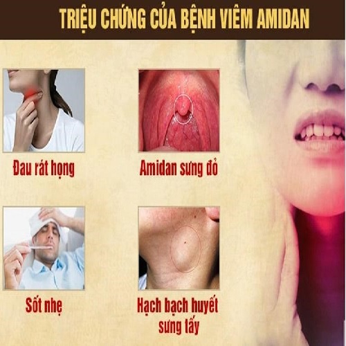 Viêm amidan ở người lớn 