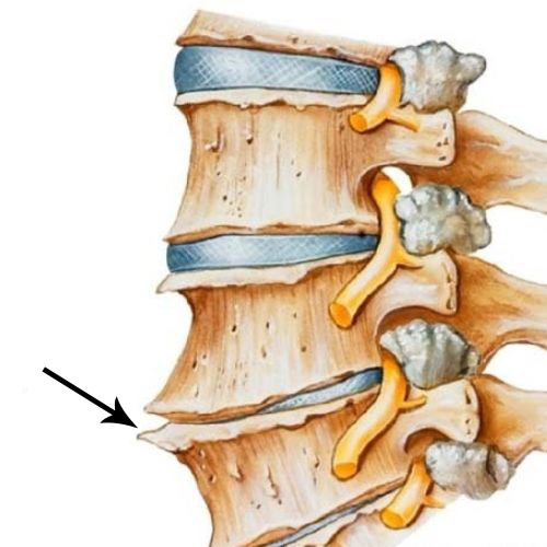 Hình ảnh gai xương cột sống