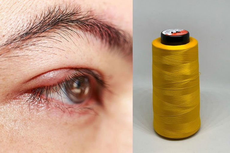 Mẹo chữa lẹo mắt bằng chỉ có an toàn không? Thực hiện thế nào?