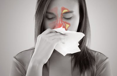 Viêm xoang cấp mủ là một dạng viêm nhiễm cấp tính ở các xoang trong cơ thể