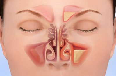 Viêm xoang mũi là một bệnh lý viêm nhiễm xảy ra trong các xoang mũi, nơi các hốc xoang quanh mũi bị viêm