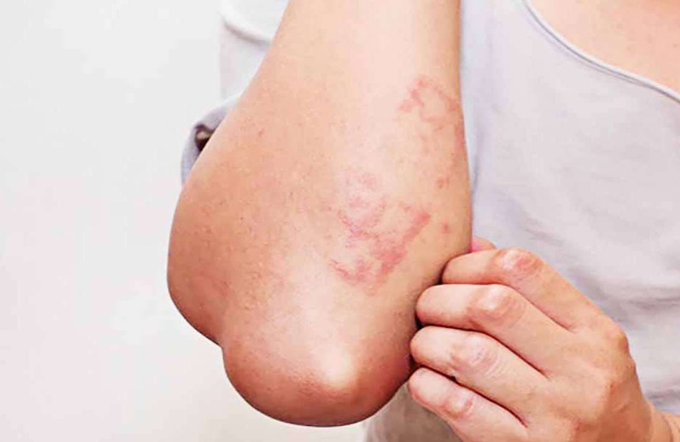 Mề đay do giun sán là phản ứng của hệ miễn dịch trước các chất độc do giun tiết ra