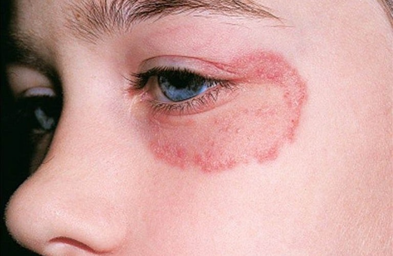 Nổi mề đay quanh mắt gây ra nhiều triệu chứng khó chịu cho người bệnh