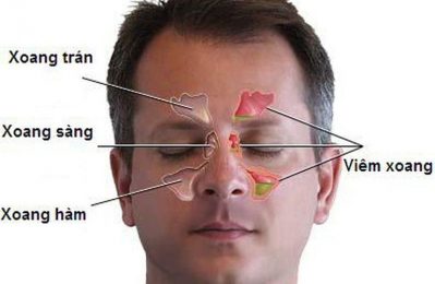 Viêm xoang sàng là tình trạng viêm nhiễm nằm sâu trong hộp sọ, giữa mắt và mũi