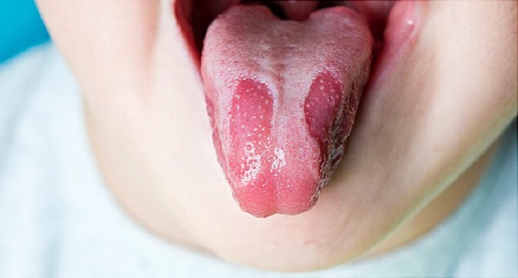 Có rất nhiều nguyên nhân khiến lưỡi trẻ 3 tuổi bị trắng