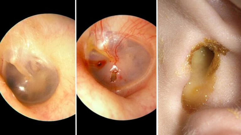 đau nhức tai bên trái có thể là do thủng màng nhĩ 