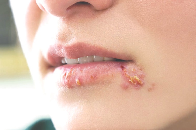 Bệnh Herpes cũng là nguyên nhân khiến người bệnh bị ngứa rát quanh miệng