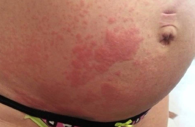 Bà Bầu Bị Nổi Mẩn Ngứa: Nguyên Nhân Và Cách Điều Trị An Toàn
