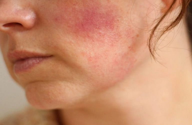 Da Mặt Khô Ngứa Mẩn Đỏ: Nguyên Nhân, Cách Điều Trị Hiệu Quả