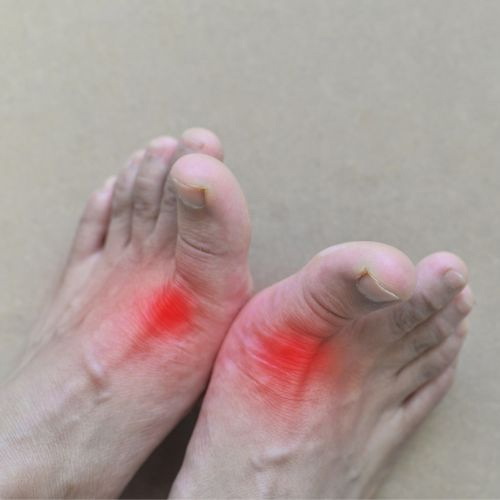 Gout theo góc nhìn của y học cổ truyền