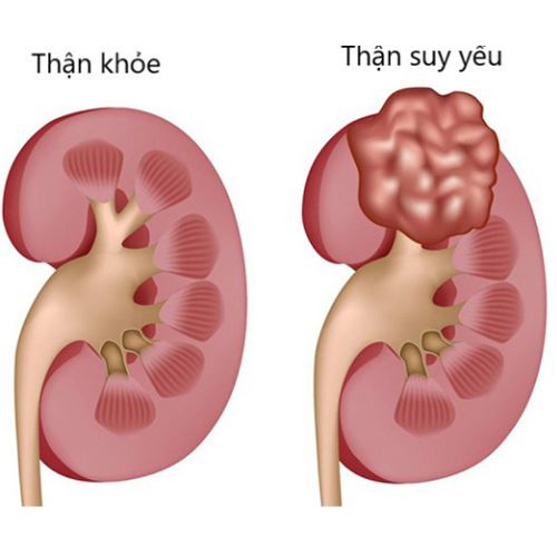 Điều trị thận hư bằng y học cổ truyền (YHCT)