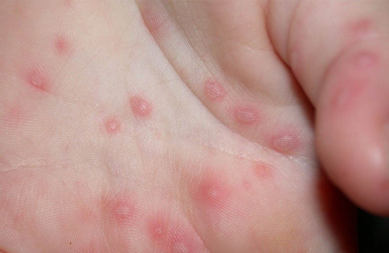 Mẩn Ngứa Ở Trẻ: Nguyên Nhân, Triệu Chứng Và Cách Điều Trị