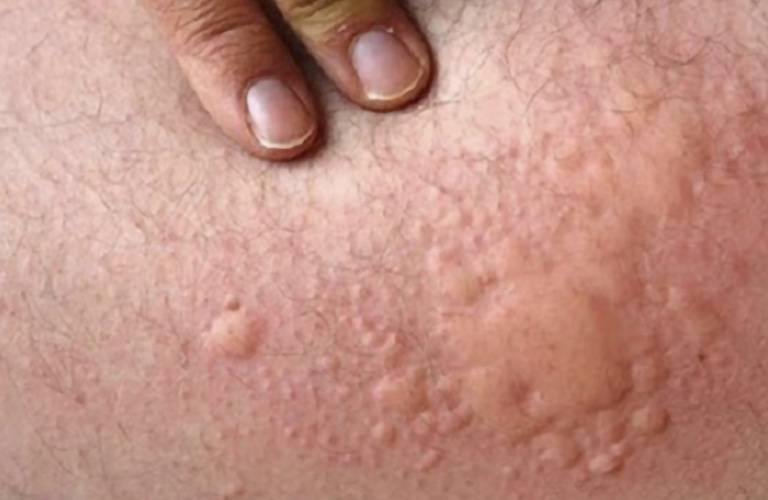 Nổi Mẩn Ngứa Ở Mông: Nguyên Nhân, Triệu Chứng, Cách Điều Trị