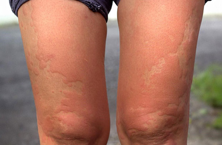 Bà Bầu Bị Nổi Mẩn Ngứa Ở Chân: Nguyên Nhân Và Cách Điều Trị