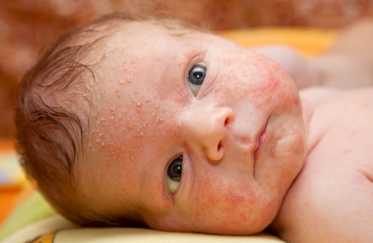 Nguyên nhân, Cách Phòng Ngừa Và Điều Trị Khi Bé Nổi Mẩn Đỏ