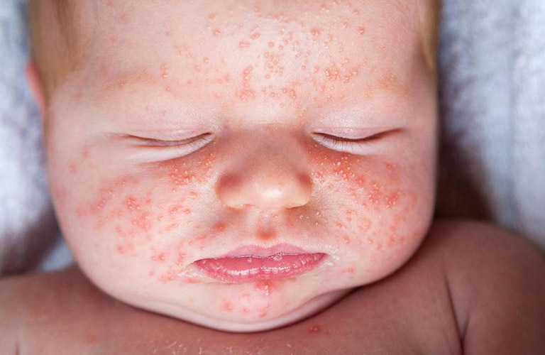 Các Cách Chữa Nổi Mẩn Đỏ Ở Trẻ Sơ Sinh An Toàn Và Hiệu Quả