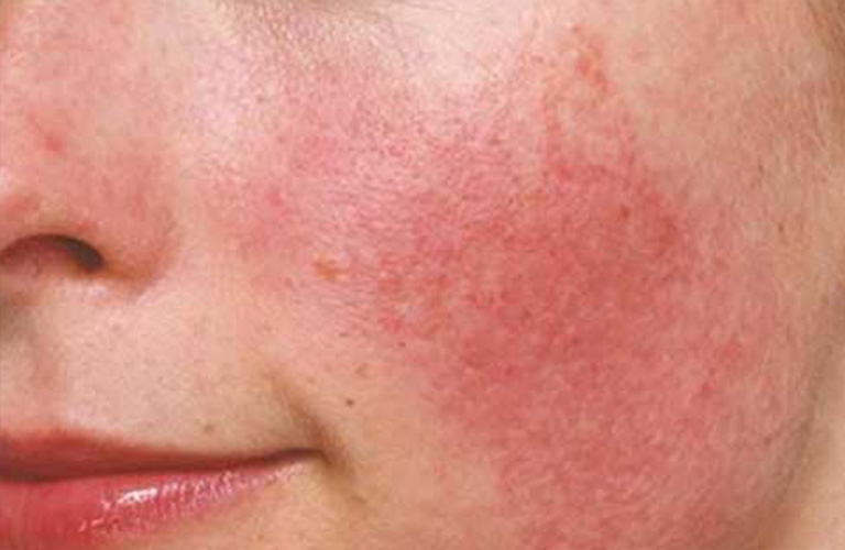 Dị Ứng Da Mặt Mẩn Đỏ Ngứa: Nguyên Nhân Và Cách Điều Trị 