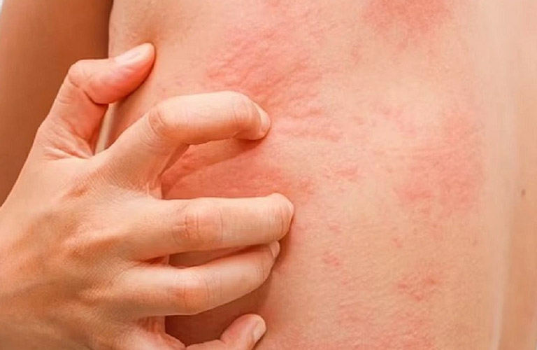 Bà con có thể theo dõi các triệu chứng của bệnh theo những thông tin Tuấn tôi cung cấp