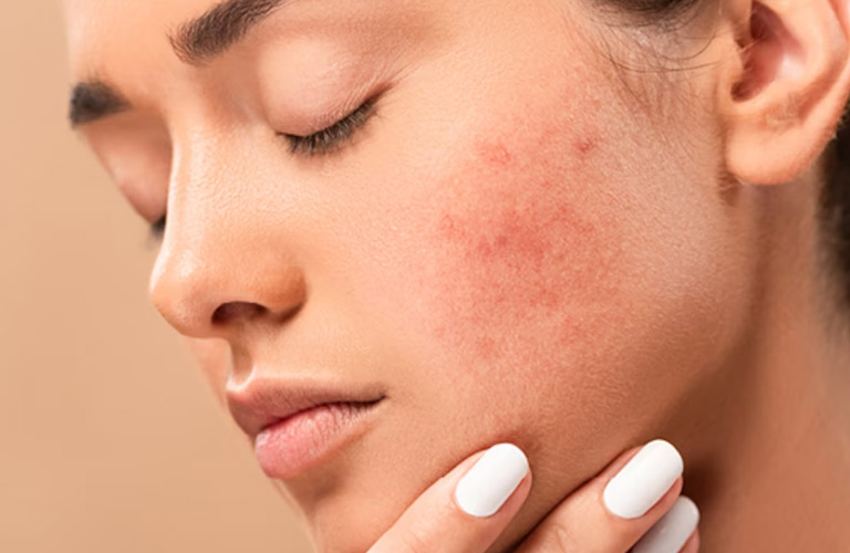 Mặt Nổi Mẩn Đỏ Không Ngứa: Nguyên Nhân Và Điều Trị Thế Nào?