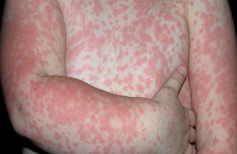 Nguyên Nhân, Cách Điều Trị Nổi Mẩn Đỏ Khắp Người Không Ngứa