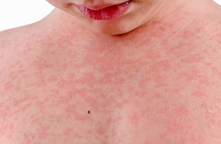 Nguyên Nhân Và Cách Điều Trị Nổi Mẩn Đỏ Không Ngứa Hiệu Quả