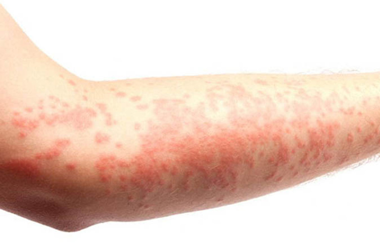 Nguyên nhân Và Cách Điều Trị Nổi Mẩn Đỏ Ngứa Như Muỗi Đốt