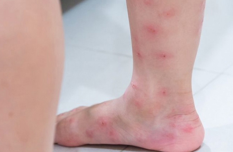 Nổi Mẩn Đỏ Ngứa Ở Chân: Nguyên Nhân, Triệu Chứng Và Cách Điều Trị